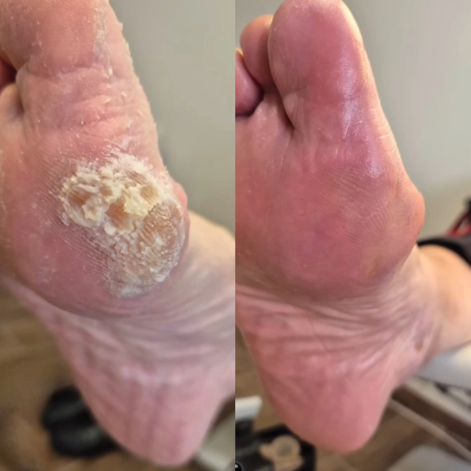 Mobile Fachfußpflege – Vorher-Nachher-Behandlung der Füße