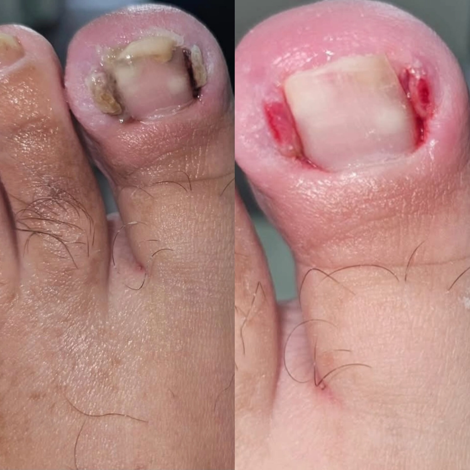 Mobile Fachfußpflege – Vorher-Nachher-Behandlung der Füße