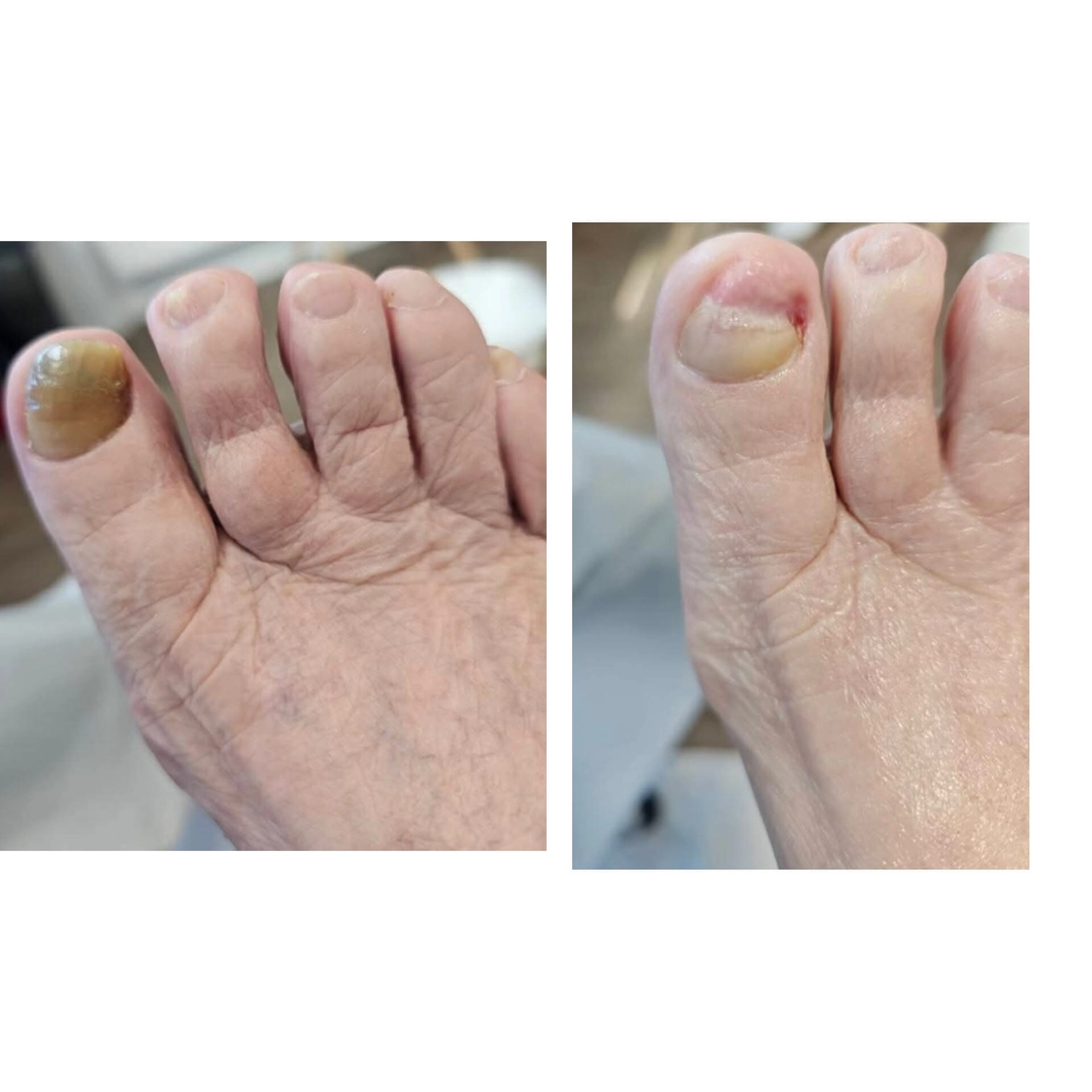 Mobile Fachfußpflege – Vorher-Nachher-Behandlung der Füße