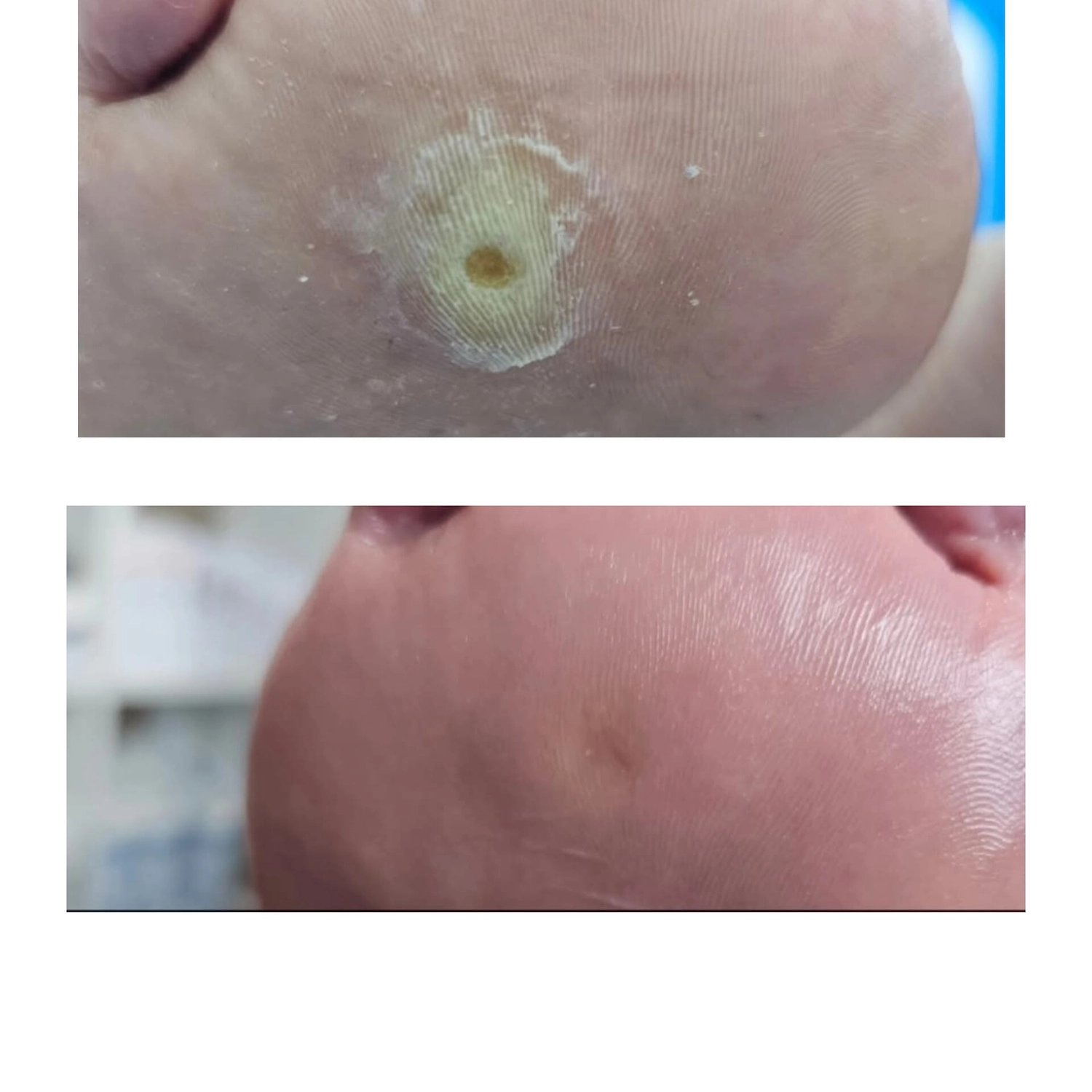 Mobile Fachfußpflege – Vorher-Nachher-Behandlung der Füße