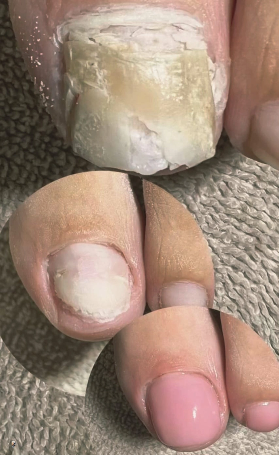 Mobile Fachfußpflege – Vorher-Nachher-Behandlung der Füße