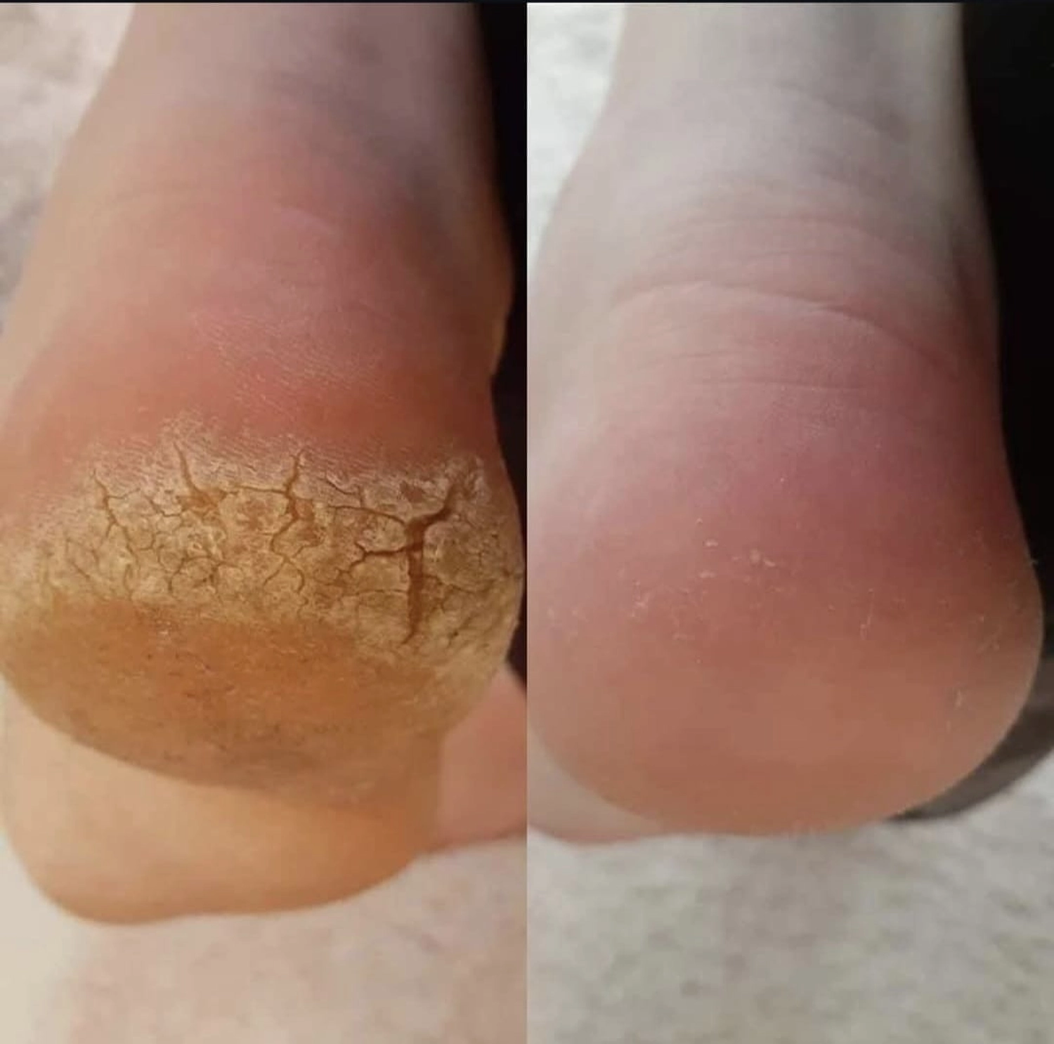 Mobile Fachfußpflege – Vorher-Nachher-Behandlung der Füße