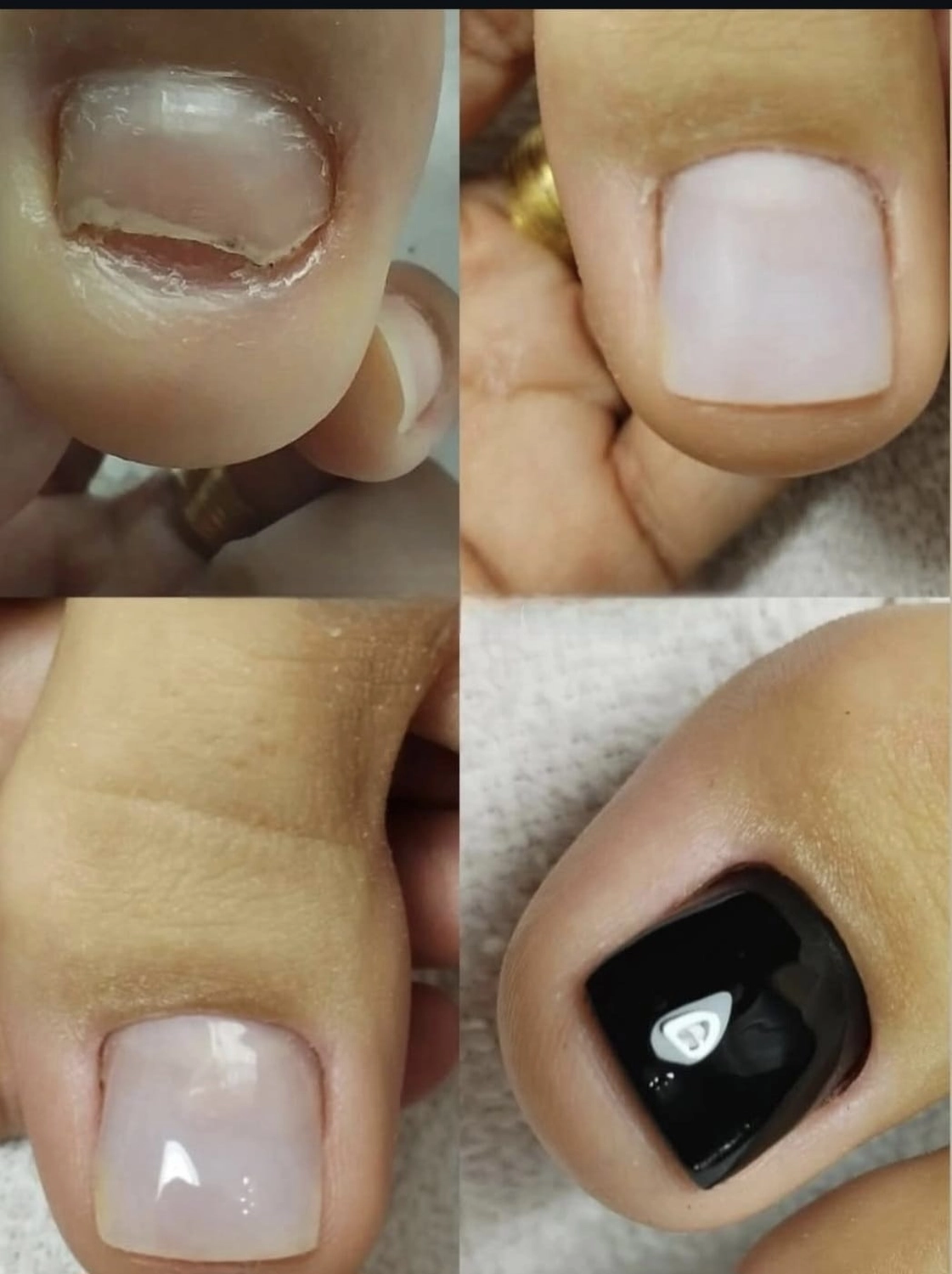 Mobile Fachfußpflege – Vorher-Nachher-Behandlung der Füße