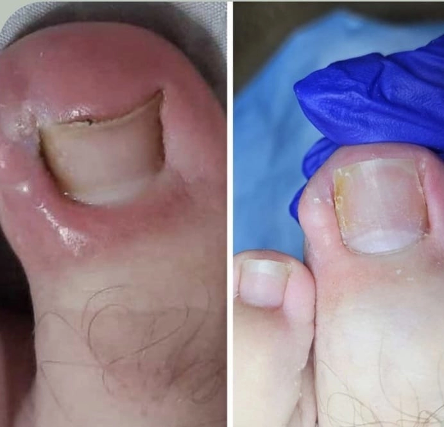 Mobile Fachfußpflege – Vorher-Nachher-Behandlung der Füße