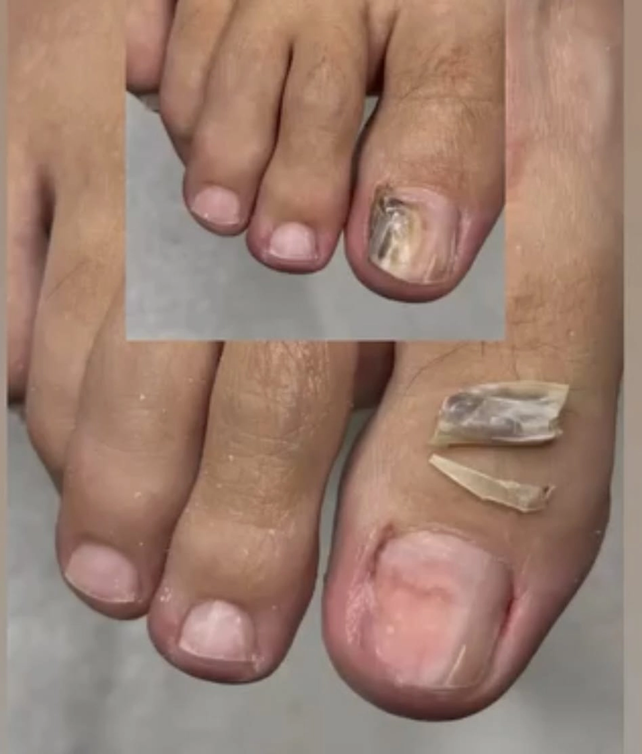 Mobile Fachfußpflege – Vorher-Nachher-Behandlung der Füße