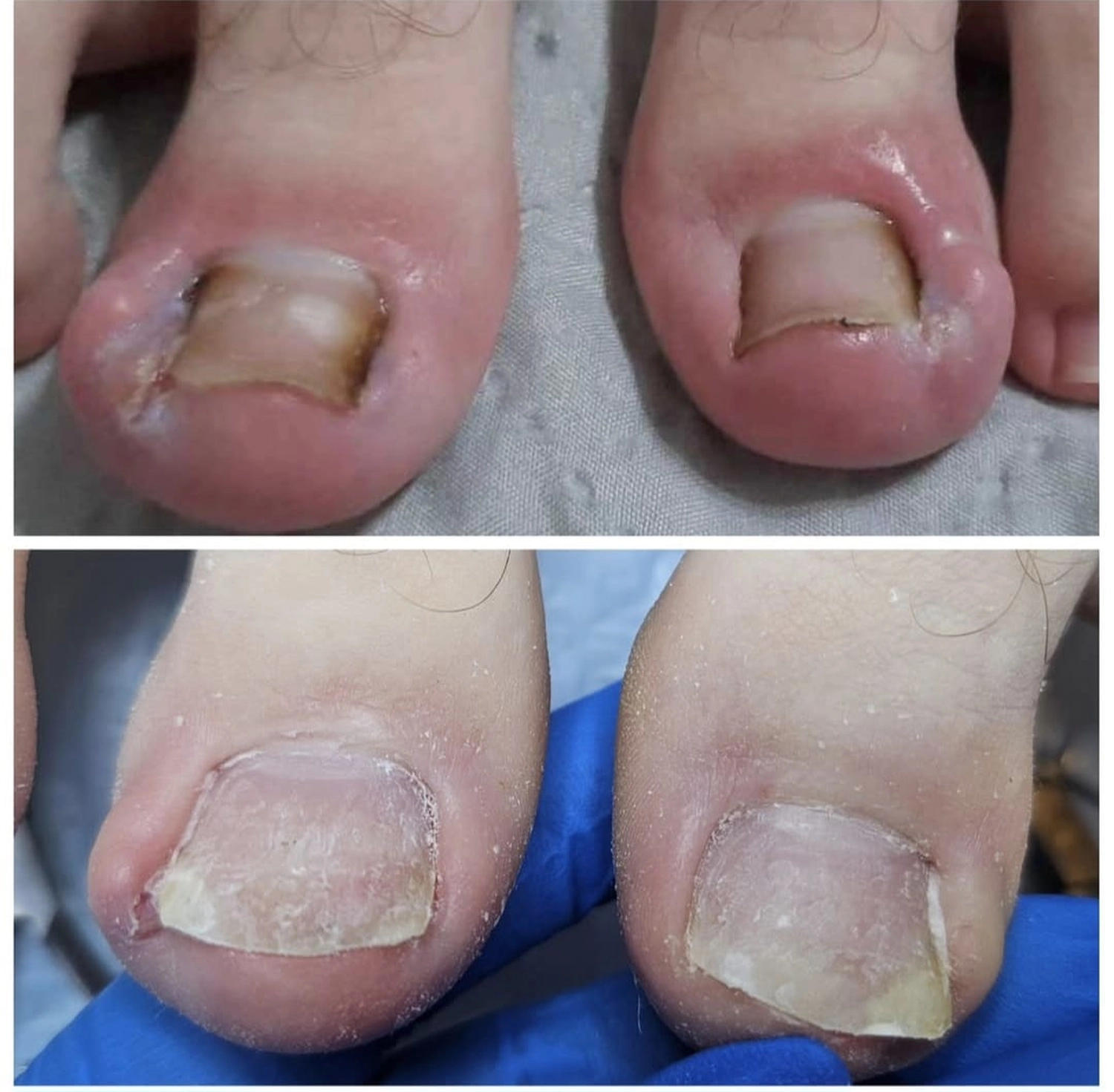 Mobile Fachfußpflege – Vorher-Nachher-Behandlung der Füße