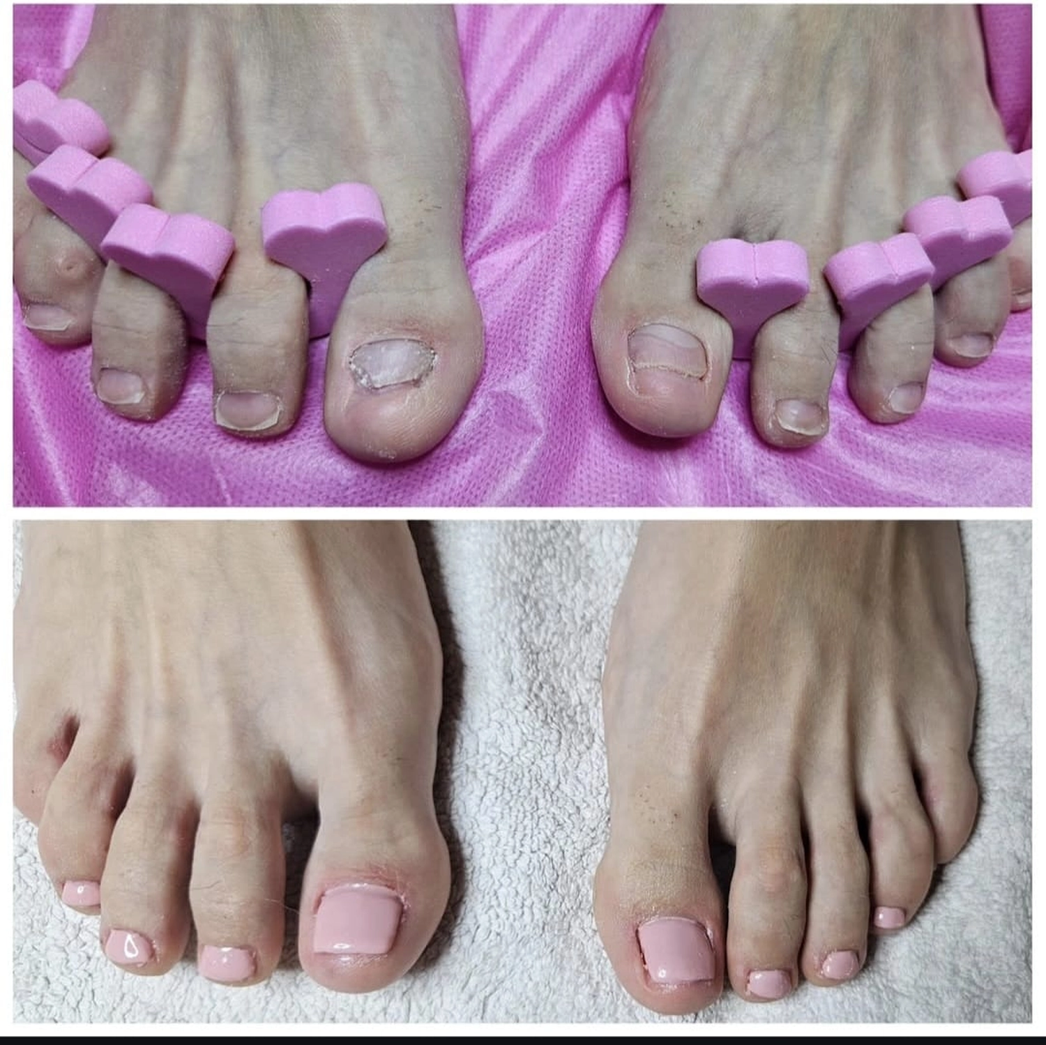 Mobile Fachfußpflege – Vorher-Nachher-Behandlung der Füße