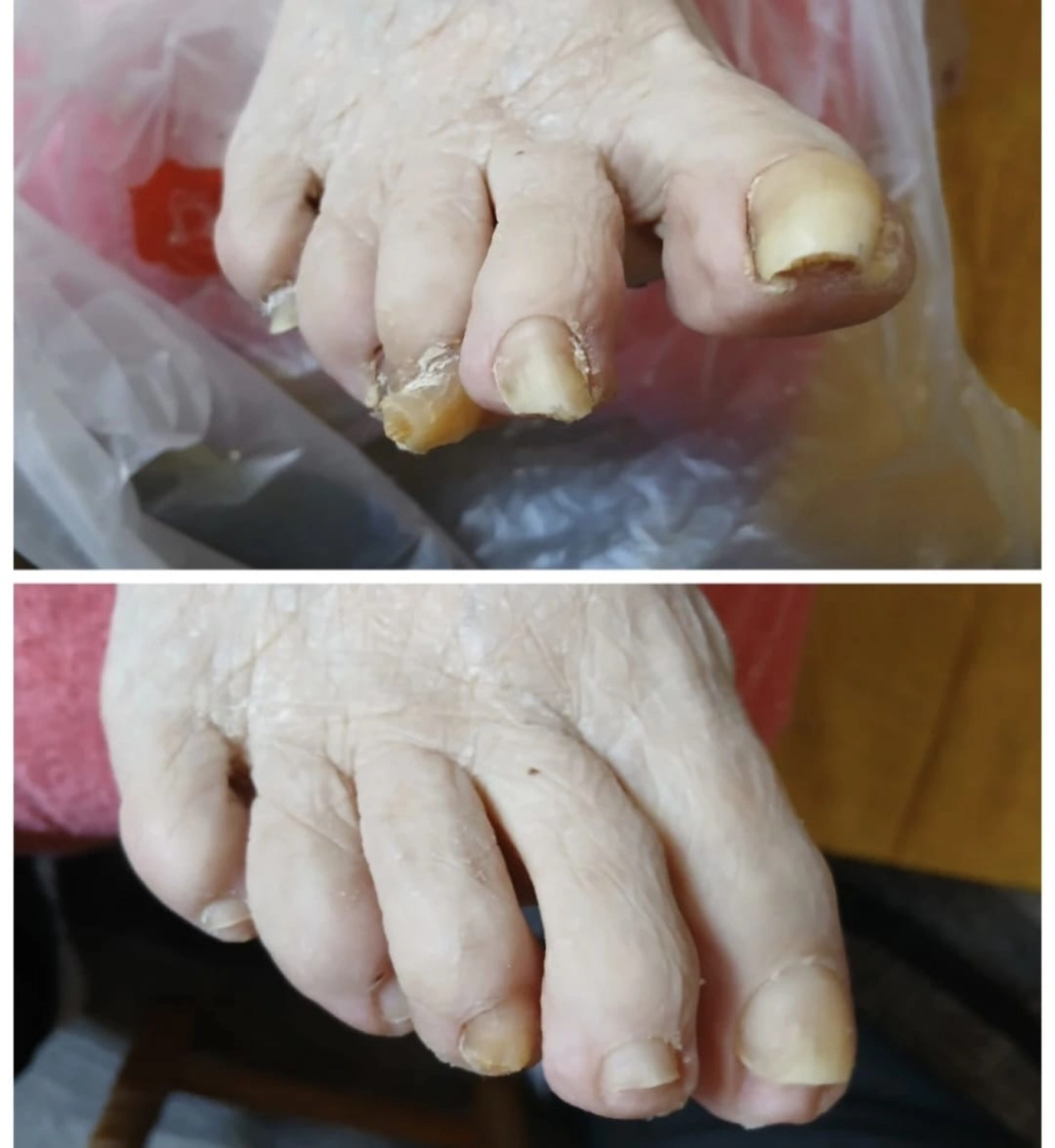 Mobile Fachfußpflege – Vorher-Nachher-Behandlung der Füße