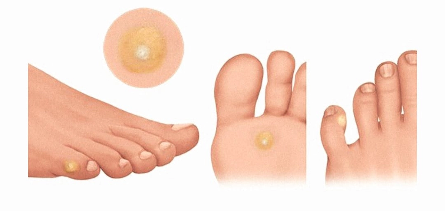 Mobile Fachfusspflege - Hühnerauge-oder Clavus