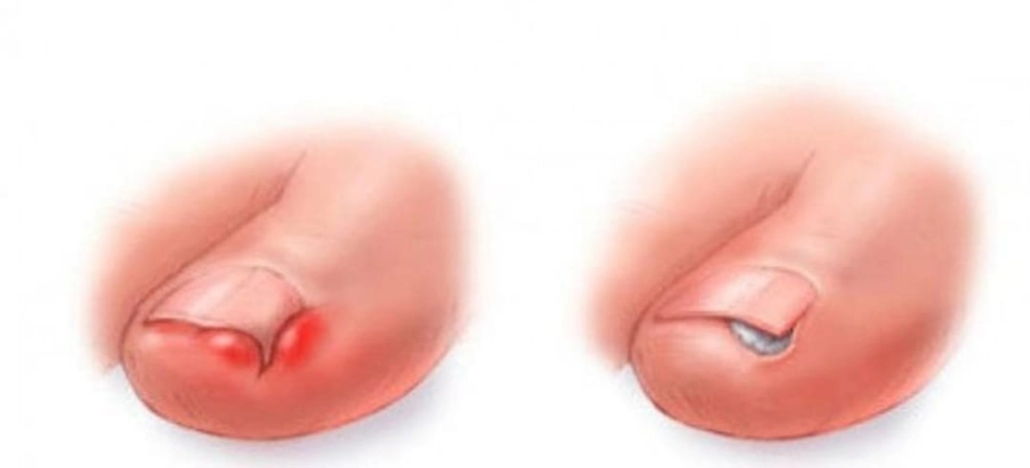 Mobile Fachfusspflege - Eingewachsener Zehnagel