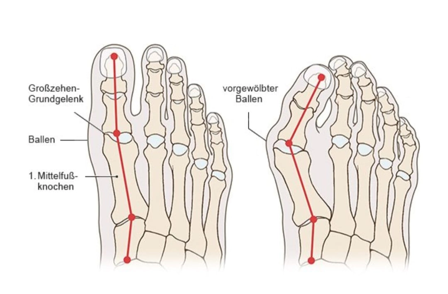 Mobile Fachfusspflege - Fehlstellung der Füsse