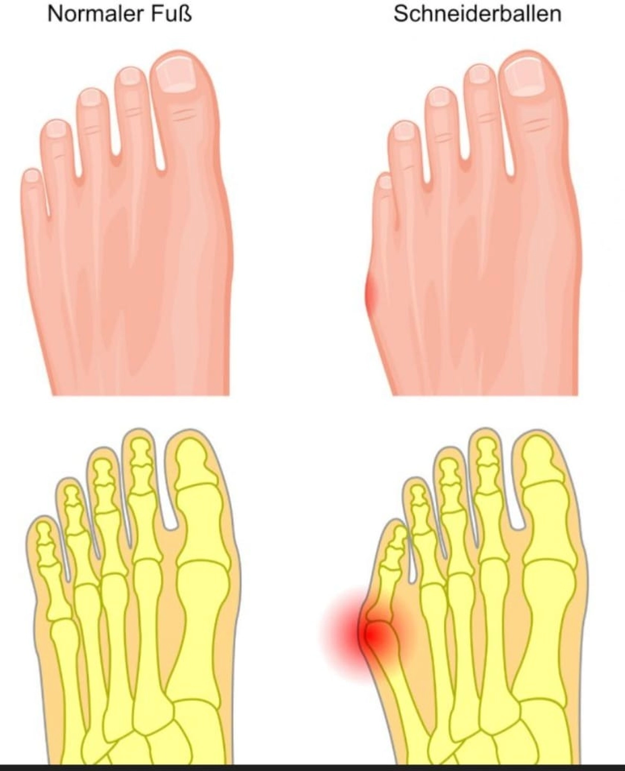 Mobile Fachfusspflege - Fehlstellung der Füsse