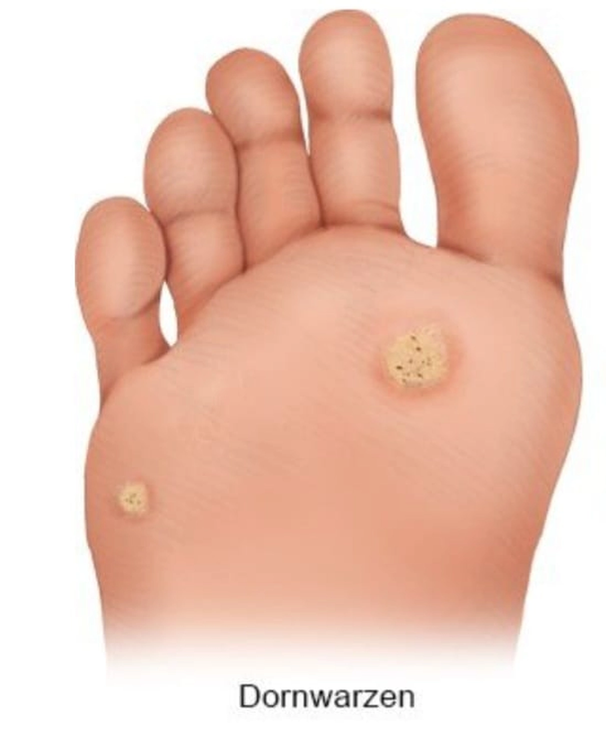 Mobile Fachfusspflege - Warze- Verrucae