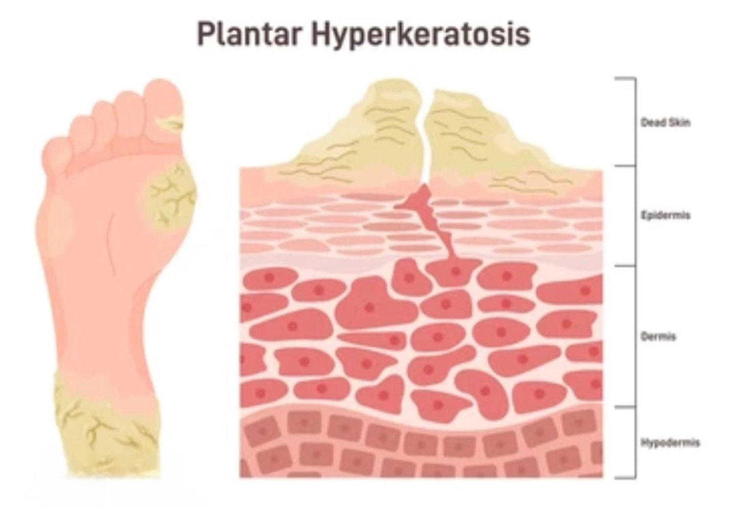 Mobile Fachfußpflege - Behandlung von extremer Hornhaut - Hyperkeratosen
